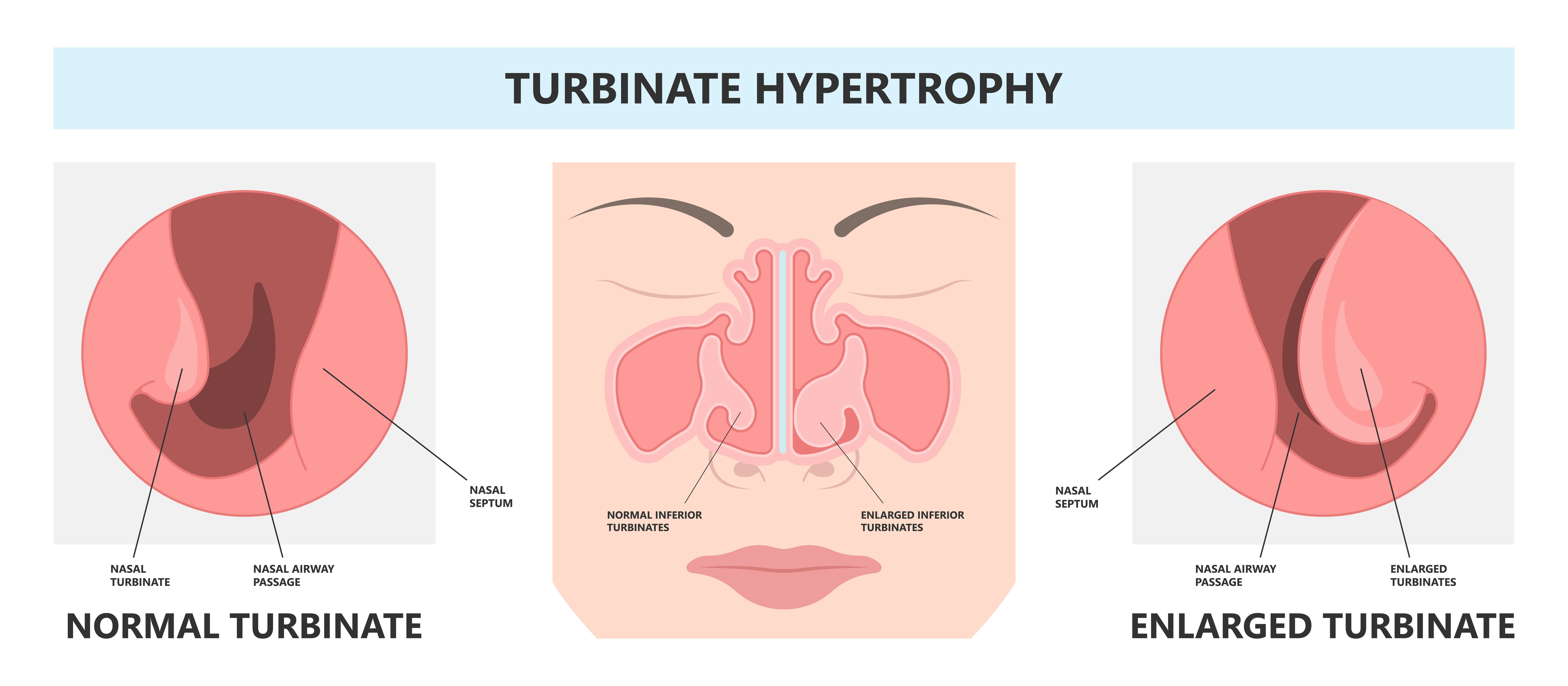 Three graphs showing Turbinate Hypertrophy.