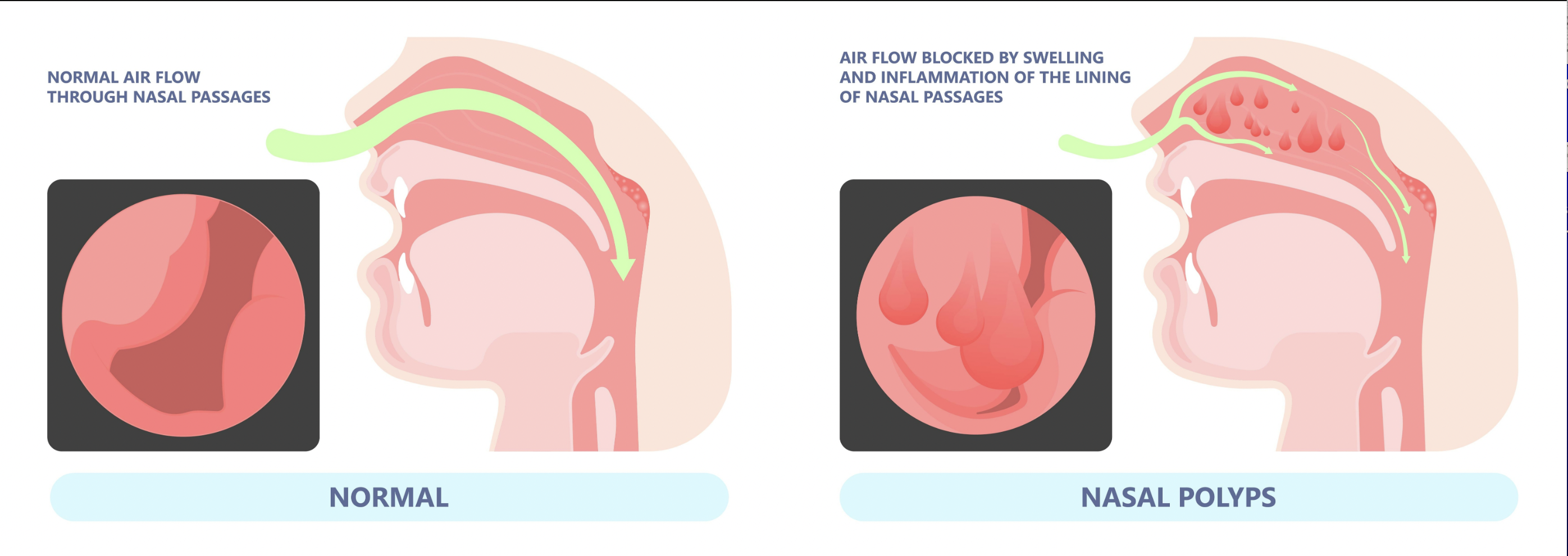 Nasal Polyps infographic and comparison illustration.