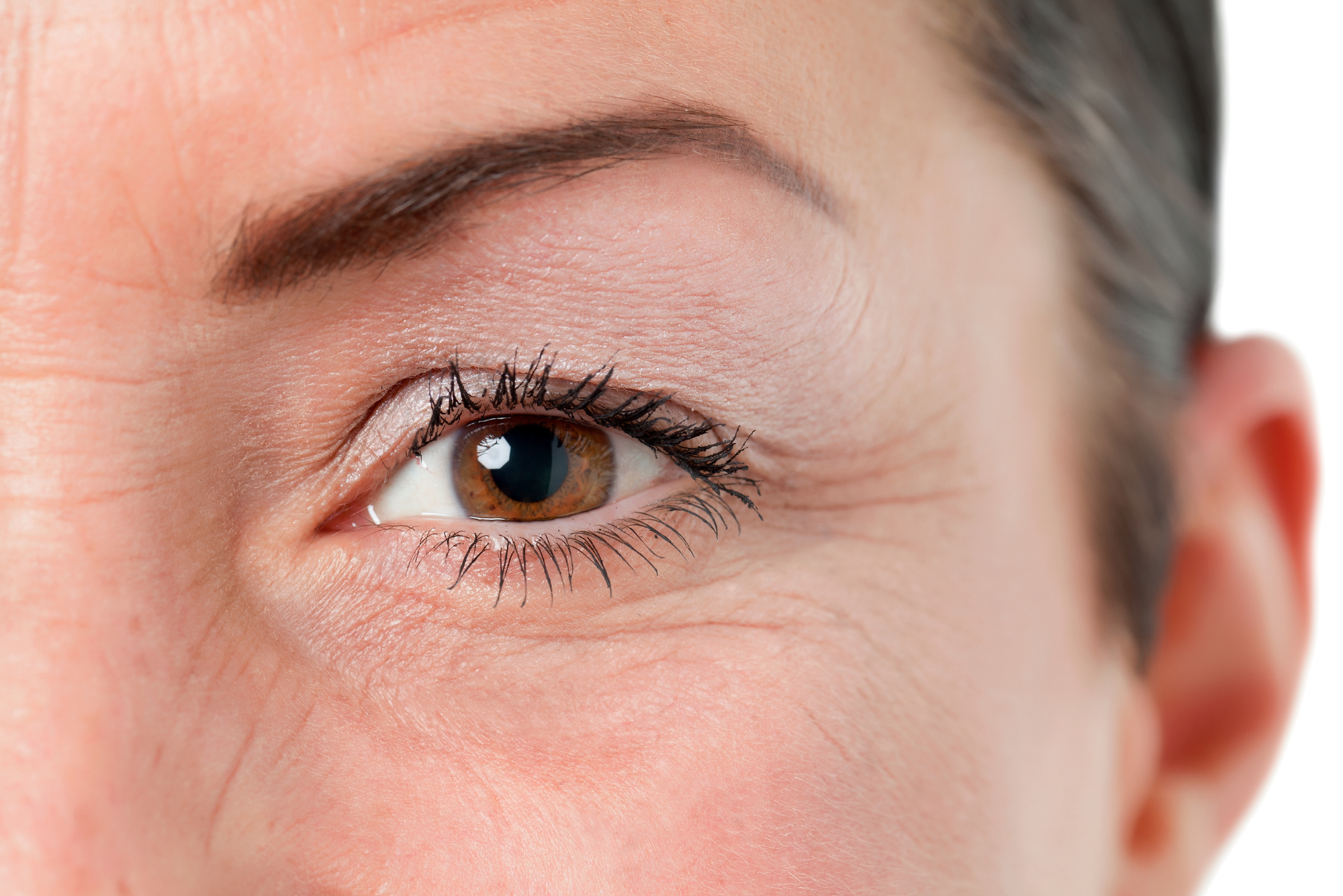 An older woman looks into the camera, about to receive Botox under her eyes.