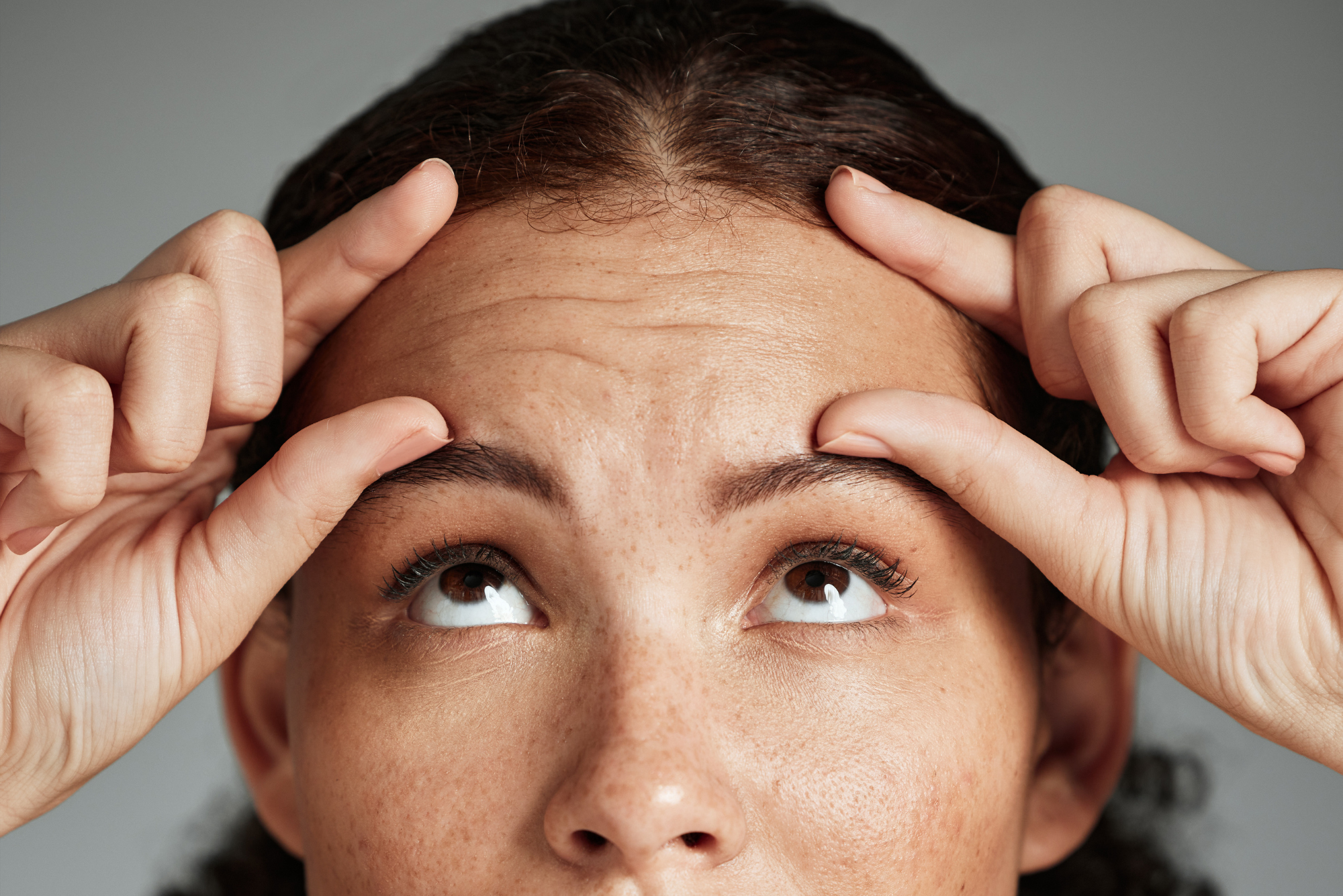 A woman pinches her forehead, showing that she needs Botox for her prominent forehead wrinkles.
