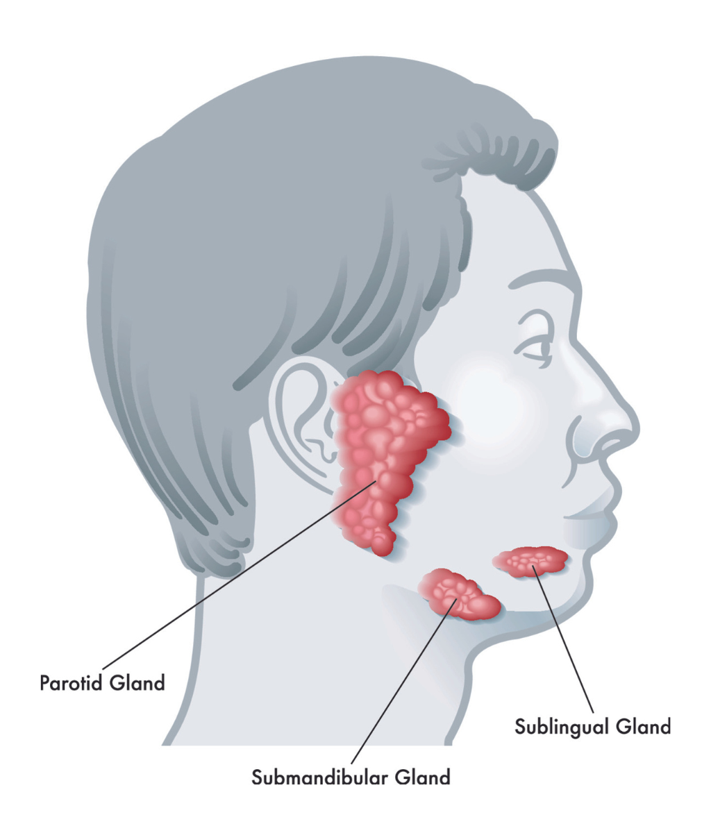 Infographic: Superficial vs. Total Parotidectomy: What to Expect